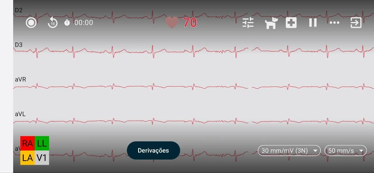 Captura de ECG multi-derivações ao vivo no app INpulse One (celular)