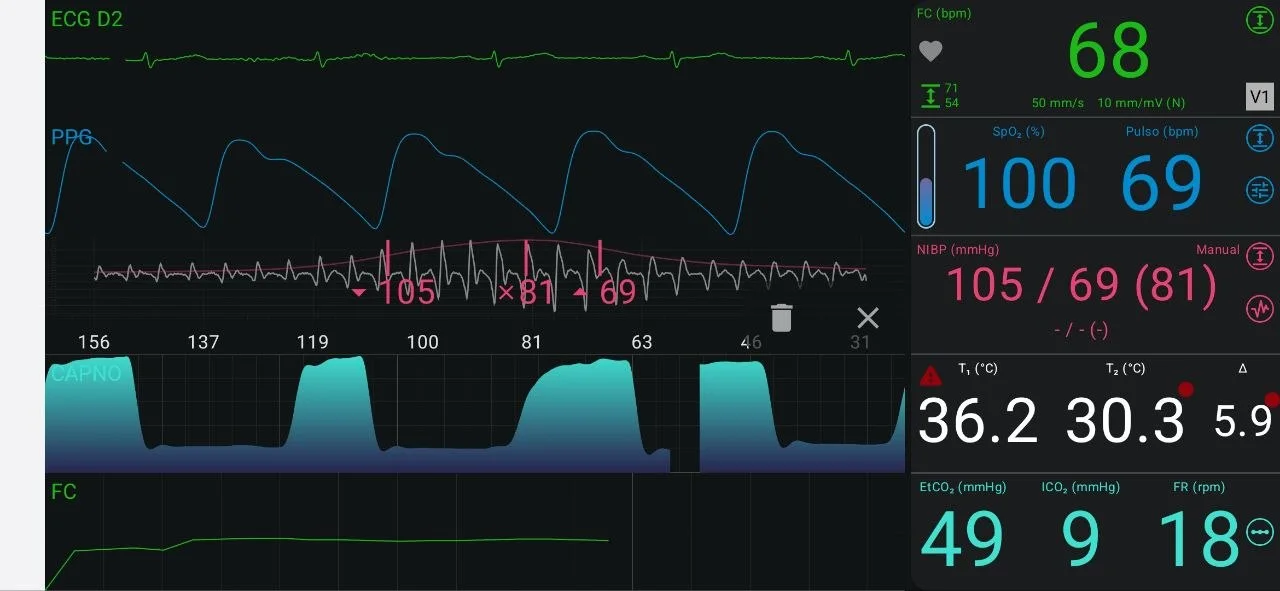 Monitorização no app INpulse One (celular): ECG, PPG, capnografia e vitais